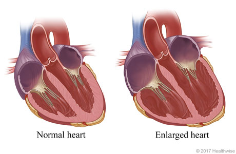 Normal heart and an enlarged (dilated) heart