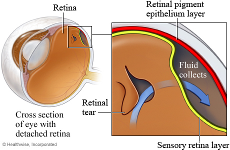 A detached retina.