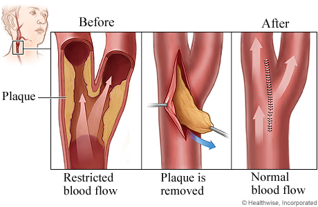 endarterectomy