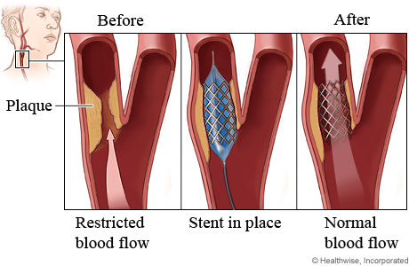 Carotid angioplasty procedure.