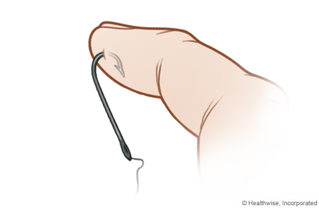 Alternate method of fish hook removal, step A