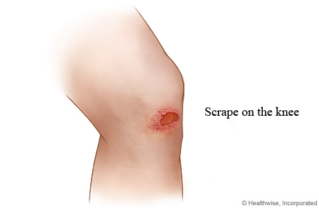 Picture of a scrape on the knee.