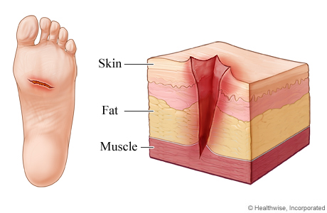 Picture of a skin laceration.