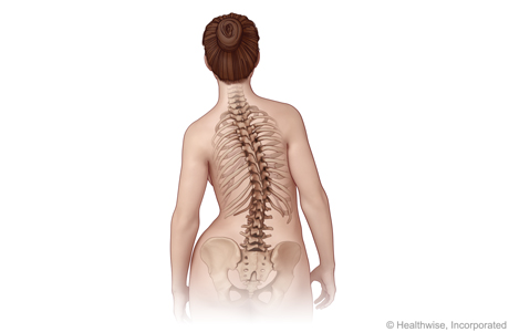 Local teens given another option to treat their scoliosis, Lifestyle