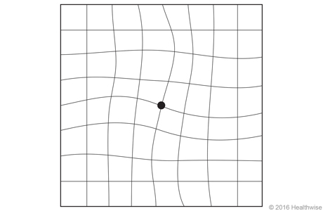 Amsler grid with wavy lines