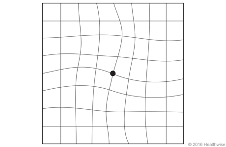 Canadian Association of Optometrists on X: Early signs of  #maculardegeneration can include waviness, distortion, blurring or missing  areas on the Amsler grid. These changes may indicate a problem or worsening  of #AMD.