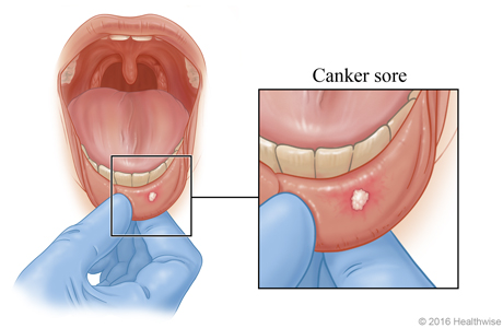 Canker sore on the inside of the lip