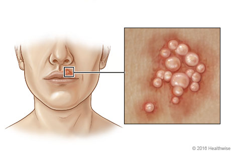 Location of cold sores near mouth, with close-up of blisters.