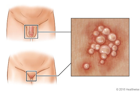 Location of genital herpes, with close-up of blisters.