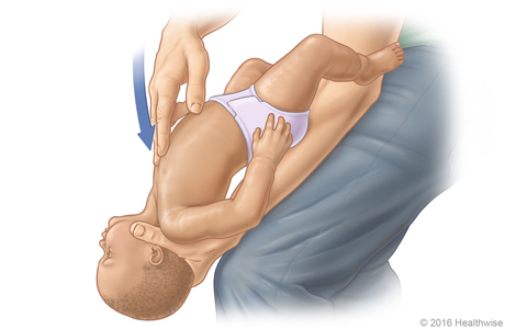 Picture D: Position of baby on thigh for Heimlich manoeuvre, showing position and direction of chest thrusts