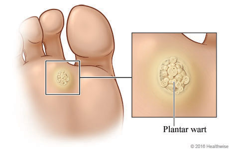 Berruga planta del pie