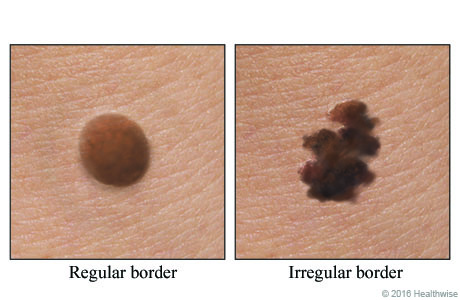 A normal mole and a mole with a ragged, notched border