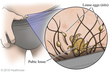 Pubic lice in top band of underwear, with close-up of louse and eggs (nits)