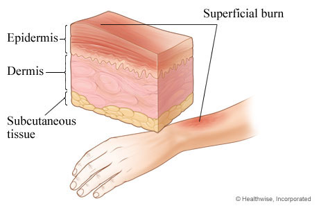 First-degree burn: superficial burn.