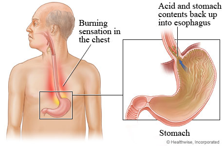Heartburn from stomach to esophagus