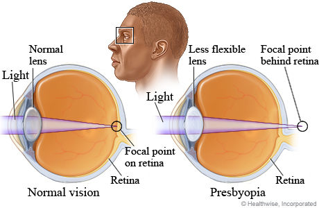 What causes presbyopia (blurred near vision).