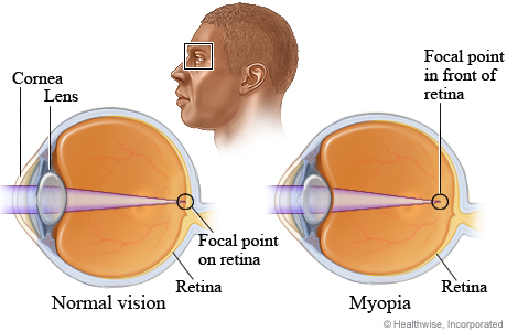 What causes myopia (nearsightedness)