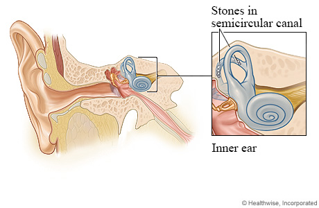 Ear anatomy, with detail of stones in semicircular canal.
