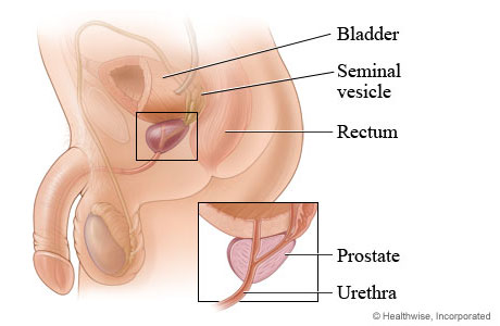 Prostate and its location in the body.