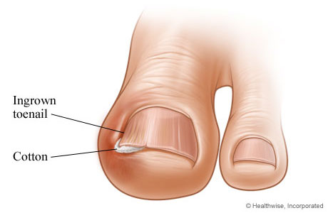 How to treat an ingrown toenail