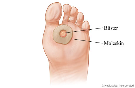 How to treat a blister