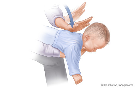 Choking rescue procedure (Heimlich manoeuvre) for a small child.