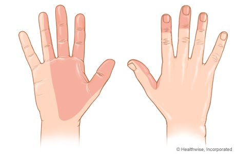 Areas of skin feeling supplied by the median nerve.