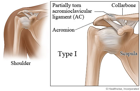 Type I shoulder separation.