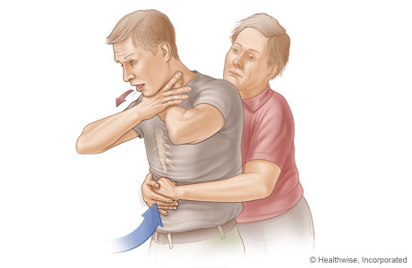 Picture B: Side view of Heimlich manoeuvre in an adult or child, showing position of hands and direction of thrust