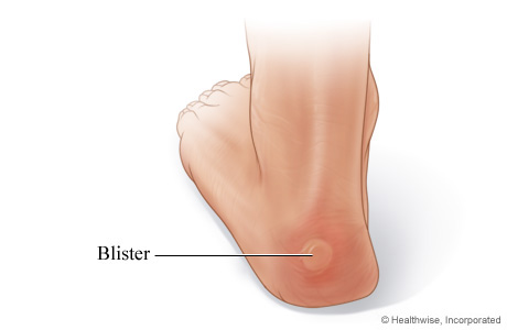 Blisters of the feet.