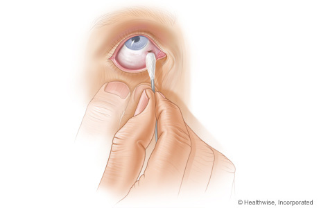 How to remove an object from the eye.
