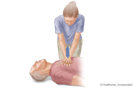 Picture of arm and body positions for doing chest compressions