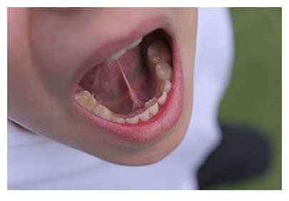 Eiffel tower tongue tie, underdeveloped jaw and crowding not enough space for adult teeth