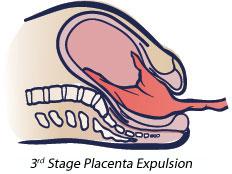 Diagram - Third Stage Placenta Expulsion