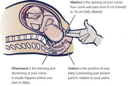 first stage of labour - dilation
