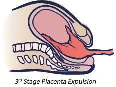 Third Stage Labour
