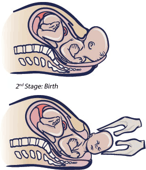 Second Stage of Labour